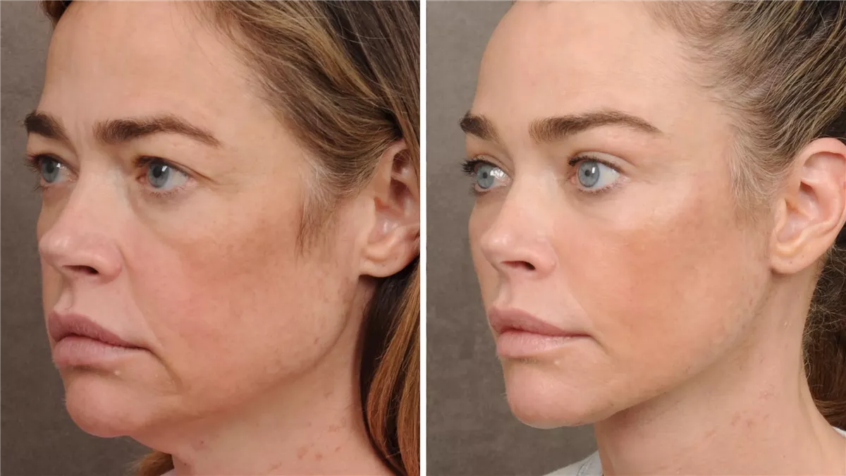 دنيس ريتشاردز حالياً قبل وبعد عمليات التجميل