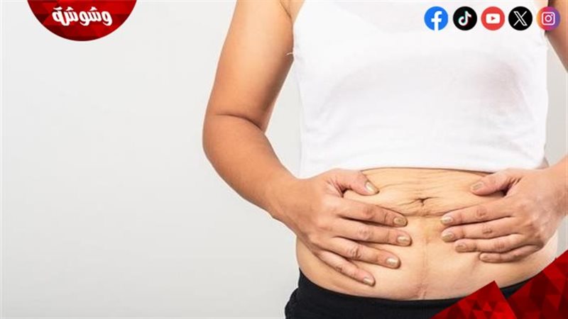 ترهلات البطن
