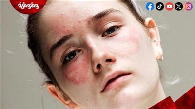 خاص.. كورتيزون الوجه سلاح ذو حدين في علاج مشاكل البشرة