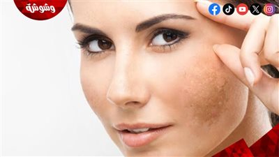 إليكِ أسباب ظهور الكلف وعلاجه مع خبيرة التجميل آبي