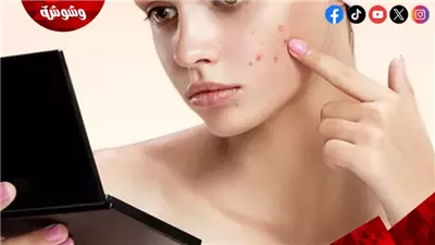 6 علاجات منزلية للتخلص من بثور الوجه في الصيف