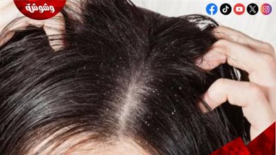 3ماسكات طبيعية للتخلص من قشرة الرأس بسهولة