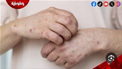 كيف تحمى نفسك من الاصابة بجدري القرود