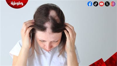 أسباب الثعلبة عند النساء في سن الخمسين