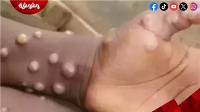 أستاذ مناعة: يطمئن المواطنين بشأن تفشي جدري القرود‎