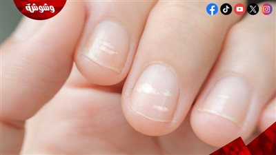 أسباب ظهور بقع بيضاء على الأظافر