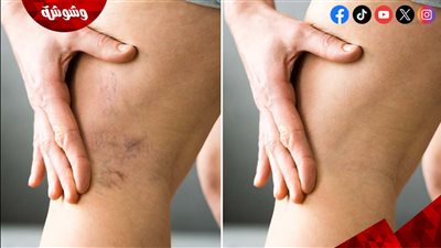 أسباب حدوث الدوالي أثناء الحمل
