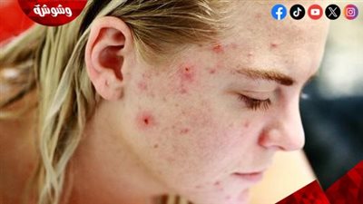نصائح للتخلص من الاحمرار الناتج عن حب الشباب