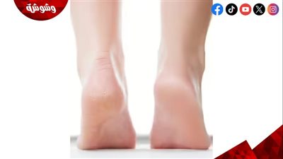 أسباب تشققات الجلد