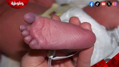 في أيامه الأولى.. تعرفِ على متلازمة الطفل الأزرق