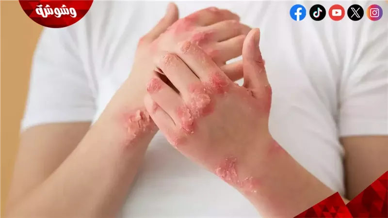 التهاب الجلد