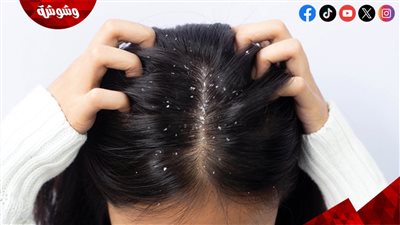 6 زيوت طبيعية لمكافحة قشرة الشعر تعرفي عليهم