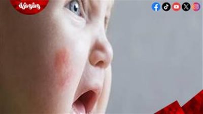 أسباب احمرار الجلد عند الأطفال.. هل يشير لحالة خطيرة؟