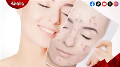 تعرف على أسباب حب الشباب وكيفية التخلص منه