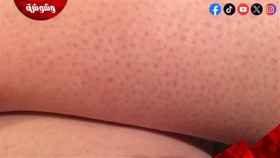  4 طرق للتخلص من جلد الفراولة.. تعرف عليها