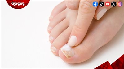 أسباب تقشر الأظافر.. هل نقص الفيتامينات؟