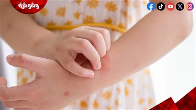 من أعراضه حكة وبثور حمراء.. تعرف على طريقة علاج هذا المرض الجلدي