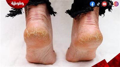 لا يفوتك.. علاجات طبيعية لتشققات الجلد 