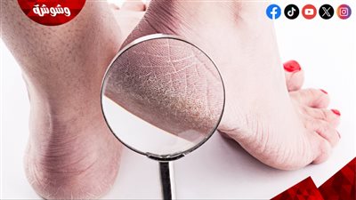 كيفية التعامل مع خشونة الكعب في المنزل؟