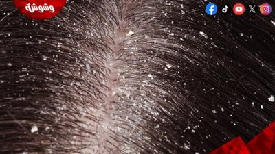 4 أخطاء قد تُصيبك بقشرة الشعر.. احذرها