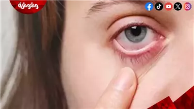 جفاف وحساسية.. لماذا تزداد آلام العين في فصل الشتاء؟