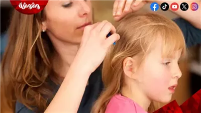4 نصائح للوقاية من قمل الرأس عند الأطفال.. تعرف عليها