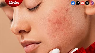 للنساء.. تعرفي على علاقة التوتر بمشاكل الجلد