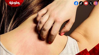 كيف يؤثر النظام الغذائي على حماية الجلد؟‎