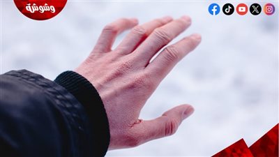 استشاري أمراض جلدية تكشف أسباب لسعة البرد.. وأهم النصائح لتجنبها