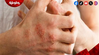 6 أعراض للحساسية الناتجة عن الحلويات.. اعرفها