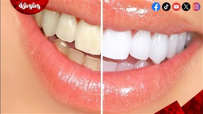 تجنبيها.. أطعمة تؤدي إلى اصفرار أسنانك 