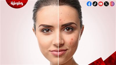 تزامنا مع فصل الصيف.. طرق علاج تصبغات البشرة 