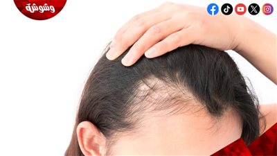 5 عوامل وراء صلع النساء‎