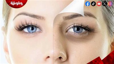منها السهر.. إليكم أسباب ظهور الهالات السوداء 