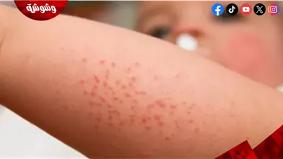 استشاري طب أطفال يوضح كيفية التخلص من حمو النيل عند الأطفال