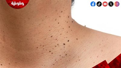 بدون أدوية.. طرق طبيعية لعلاج الزوائد الجلدية
