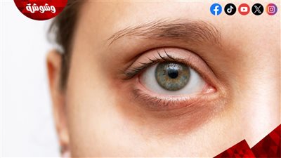 فوائد استخدام زيت اللوز للهالات السوداء.. اعرفيها 
