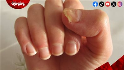 طريقة طبيعية للتخلص من فطريات أظافر القدم.. نتائجها مذهلة 