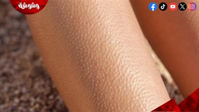 4 طرق لعلاج جلد الوزة.. تعرف عليها