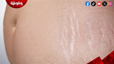 طريقة طبيعية للتخلص من علامات التمدد بعد الحمل
