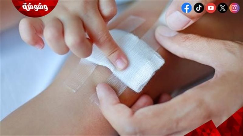 علاج الحروق
