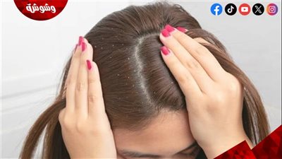 أسرار الطب البديل لعلاج القشرة والفروة الدهنية دون كيماويات