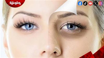 الهالات السوداء تحت العينين.. حلول منزلية فعّالة لاستعادة نضارة عينيك