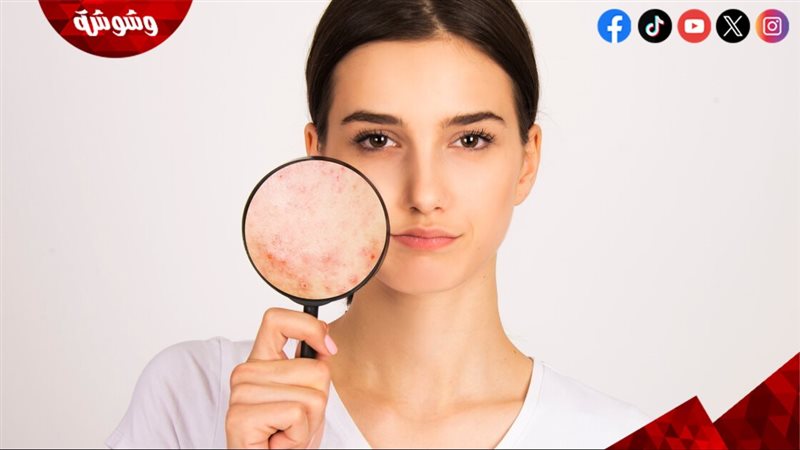 العناية بالبشرة الدهنية