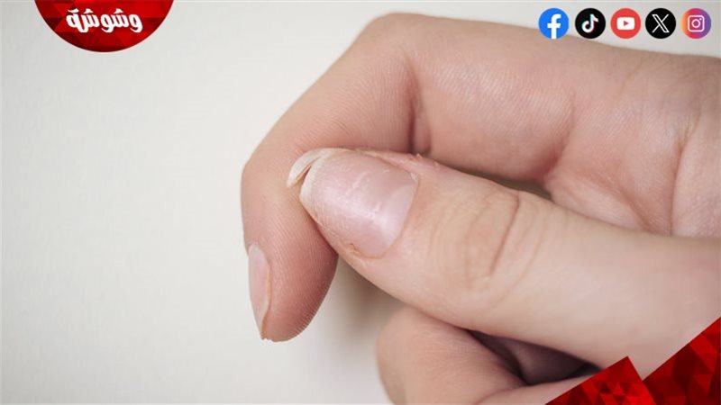 تقصف الأظافر