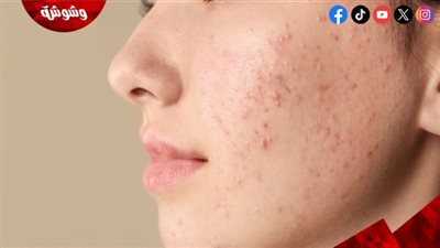 تأثير وضع المكياج الدائم على حب الشباب