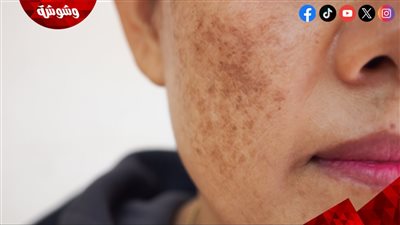 وداعًا للبقع الداكنة.. طرق فعالة لتوحيد لون البشرة