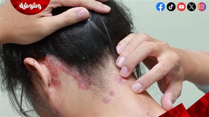  صدفية فروة الرأس