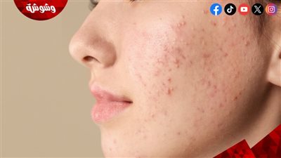 كيف يؤثر القلق على البشرة وظهور الحبوب؟