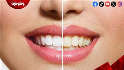 ابتسامة ناصعة بمكونات منزلية.. هل يمكن استبدال التبييض التجميلي؟